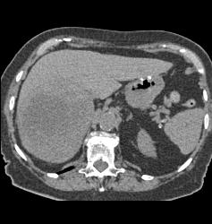 Hepatocellular Carcinoma (Hepatoma) - CTisus CT Scan