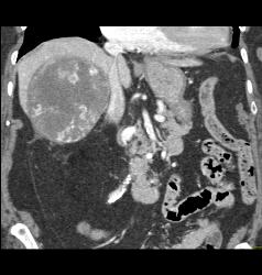 Hepatocellular Carcinoma (Hepatoma) - CTisus CT Scan