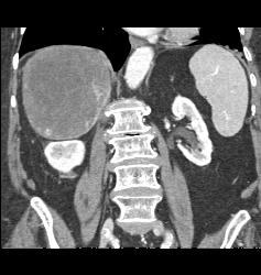 Hepatocellular Carcinoma (Hepatoma) - CTisus CT Scan