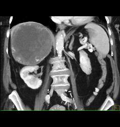 Hepatocellular Carcinoma (Hepatoma) - CTisus CT Scan