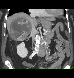 Hepatocellular Carcinoma (Hepatoma) - CTisus CT Scan