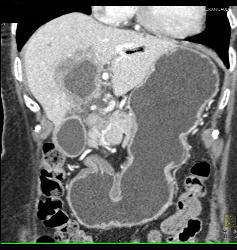 Hepatic Abscess - CTisus CT Scan