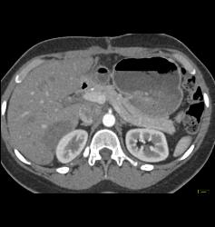 Multiple Hepatic Adenomas - CTisus CT Scan