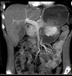 Multiple Hepatic Adenomas - CTisus CT Scan