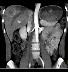 Multiple Hepatic Adenomas - CTisus CT Scan