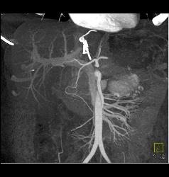 Multiple Hepatic Adenomas - CTisus CT Scan