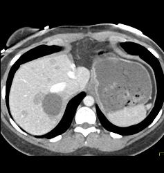 Multiple Hepatic Adenomas - CTisus CT Scan