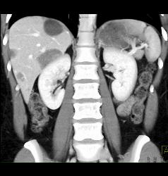 Multiple Hepatic Adenomas - CTisus CT Scan