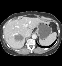 Liver Metastases - CTisus CT Scan