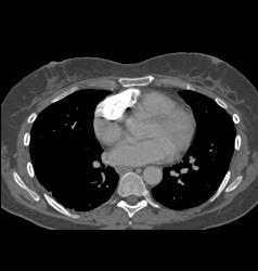 Calcified Nodes in Right Pericardial Zone - CTisus CT Scan