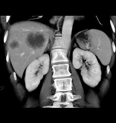 Liver Metastases - CTisus CT Scan