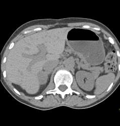 Right Adrenal Mass Simulates A Hepatic Tumor - CTisus CT Scan