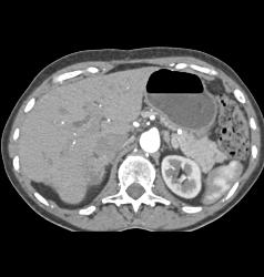 Right Adrenal Mass Simulates A Hepatic Tumor - CTisus CT Scan