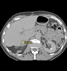 Right Adrenal Mass Simulates A Hepatic Tumor - CTisus CT Scan