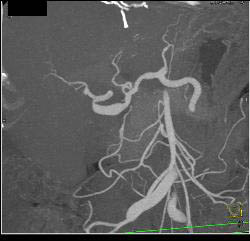 Hepatic Artery Aneurysm S/p Liver Transplant. Portal Vein Anastomosis Also Seen- See Full Sequence - CTisus CT Scan