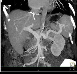 Hepatic Artery Aneurysm S/p Liver Transplant. Portal Vein Anastomosis Also Seen- See Full Sequence - CTisus CT Scan