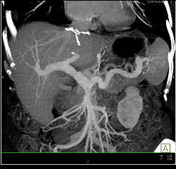 Hepatic Artery Aneurysm S/p Liver Transplant. Portal Vein Anastomosis Also Seen- See Full Sequence - CTisus CT Scan