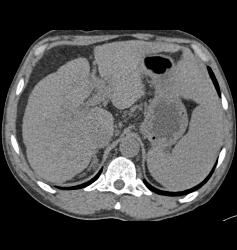 Hepatocellular Carcinoma (Hepatoma) in Patient Who Presented With Stone in Distal Right Ureter- See Neovascularity on CTA - CTisus CT Scan