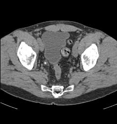 Hepatocellular Carcinoma (Hepatoma) in Patient Who Presented With Stone in Distal Right Ureter- See Neovascularity on CTA - CTisus CT Scan