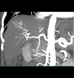 Hepatocellular Carcinoma (Hepatoma) in Patient Who Presented With Stone in Distal Right Ureter- See Neovascularity on CTA - CTisus CT Scan