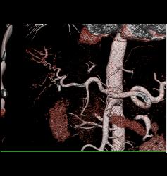 Hepatocellular Carcinoma (Hepatoma) in Patient Who Presented With Stone in Distal Right Ureter- See Neovascularity on CTA - CTisus CT Scan