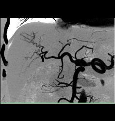 Hepatocellular Carcinoma (Hepatoma) in Patient Who Presented With Stone in Distal Right Ureter- See Neovascularity on CTA - CTisus CT Scan