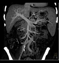 Hepatocellular Carcinoma (Hepatoma) in Patient Who Presented With Stone in Distal Right Ureter- See Neovascularity on CTA - CTisus CT Scan