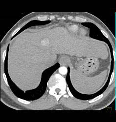 Hepatocellular Carcinoma (Hepatoma) - CTisus CT Scan