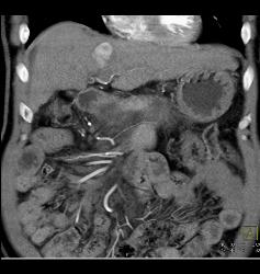 Hepatocellular Carcinoma (Hepatoma) - CTisus CT Scan