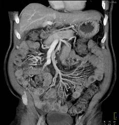 Hepatocellular Carcinoma (Hepatoma) - CTisus CT Scan