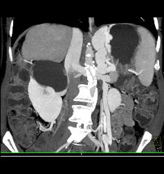 Cirrhosis With Gastric Varices - CTisus CT Scan