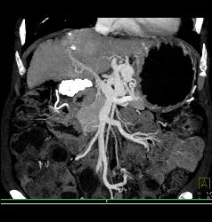 Cirrhosis With Gastric Varices - CTisus CT Scan