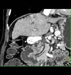 Cirrhosis With Gastric Varices - CTisus CT Scan