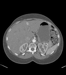 1 Cm Focal Nodular Hyperplasia (FNH) - CTisus CT Scan