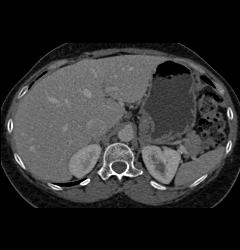 1 Cm Focal Nodular Hyperplasia (FNH) - CTisus CT Scan