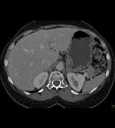 1 Cm Focal Nodular Hyperplasia (FNH) - CTisus CT Scan