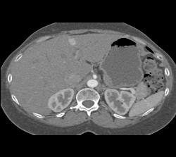 1 Cm Focal Nodular Hyperplasia (FNH) - CTisus CT Scan