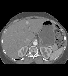 1 Cm Focal Nodular Hyperplasia (FNH) - CTisus CT Scan