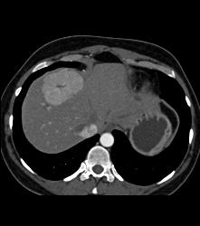 Focal Nodular Hyperplasia (FNH) With Central Scar and Feeding Vessel - CTisus CT Scan