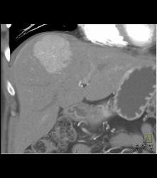 Focal Nodular Hyperplasia (FNH) With Central Scar and Feeding Vessel - CTisus CT Scan