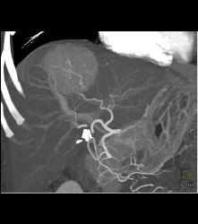 Focal Nodular Hyperplasia (FNH) With Central Scar and Feeding Vessel - CTisus CT Scan