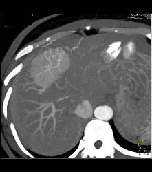 Focal Nodular Hyperplasia (FNH) With Central Scar and Feeding Vessel - CTisus CT Scan