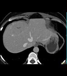 Focal Nodular Hyperplasia (FNH) With Central Scar and Feeding Vessel - CTisus CT Scan