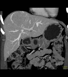 Focal Nodular Hyperplasia (FNH) With Central Scar and Feeding Vessel - CTisus CT Scan