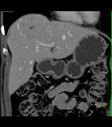 Focal Nodular Hyperplasia (FNH) With Central Scar and Feeding Vessel - CTisus CT Scan