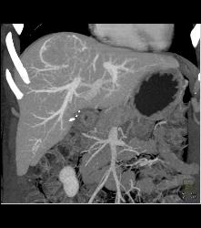 Focal Nodular Hyperplasia (FNH) With Central Scar and Feeding Vessel - CTisus CT Scan