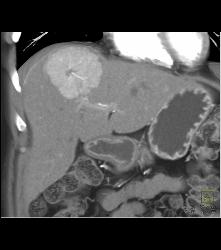 Focal Nodular Hyperplasia (FNH) With Central Scar and Feeding Vessel - CTisus CT Scan