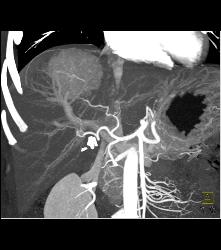 Focal Nodular Hyperplasia (FNH) With Central Scar and Feeding Vessel - CTisus CT Scan