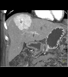 Focal Nodular Hyperplasia (FNH) With Central Scar and Feeding Vessel - CTisus CT Scan