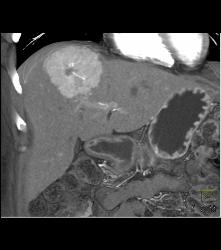 Focal Nodular Hyperplasia (FNH) With Central Scar and Feeding Vessel - CTisus CT Scan